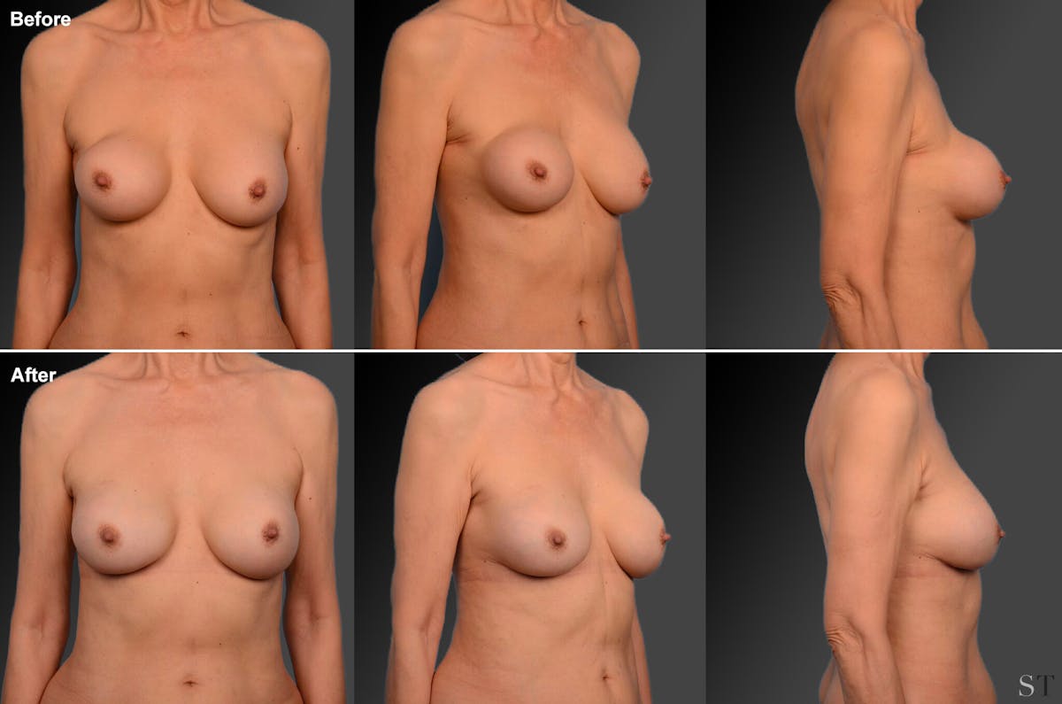 Breast Implant Revision Before & After Gallery - Patient 105600314 - Image 1