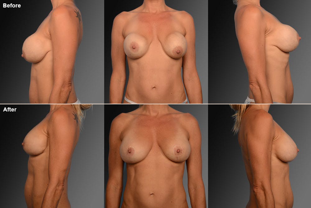 Breast Implant Revision Before & After Gallery - Patient 105600317 - Image 1