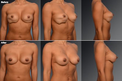 Breast Implant Revision Before & After Gallery - Patient 105600320 - Image 1
