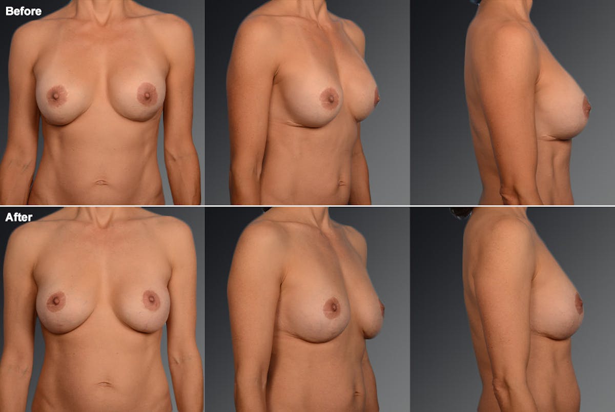 Breast Implant Revision Before & After Gallery - Patient 105600331 - Image 1