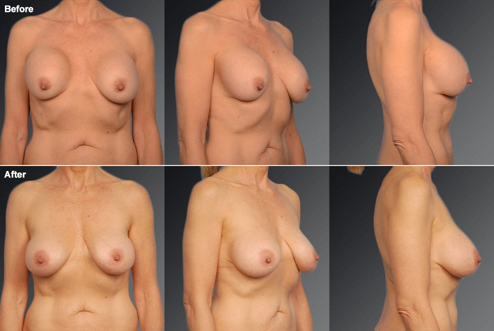Breast Implant Revision Before & After Gallery - Patient 105600334 - Image 1