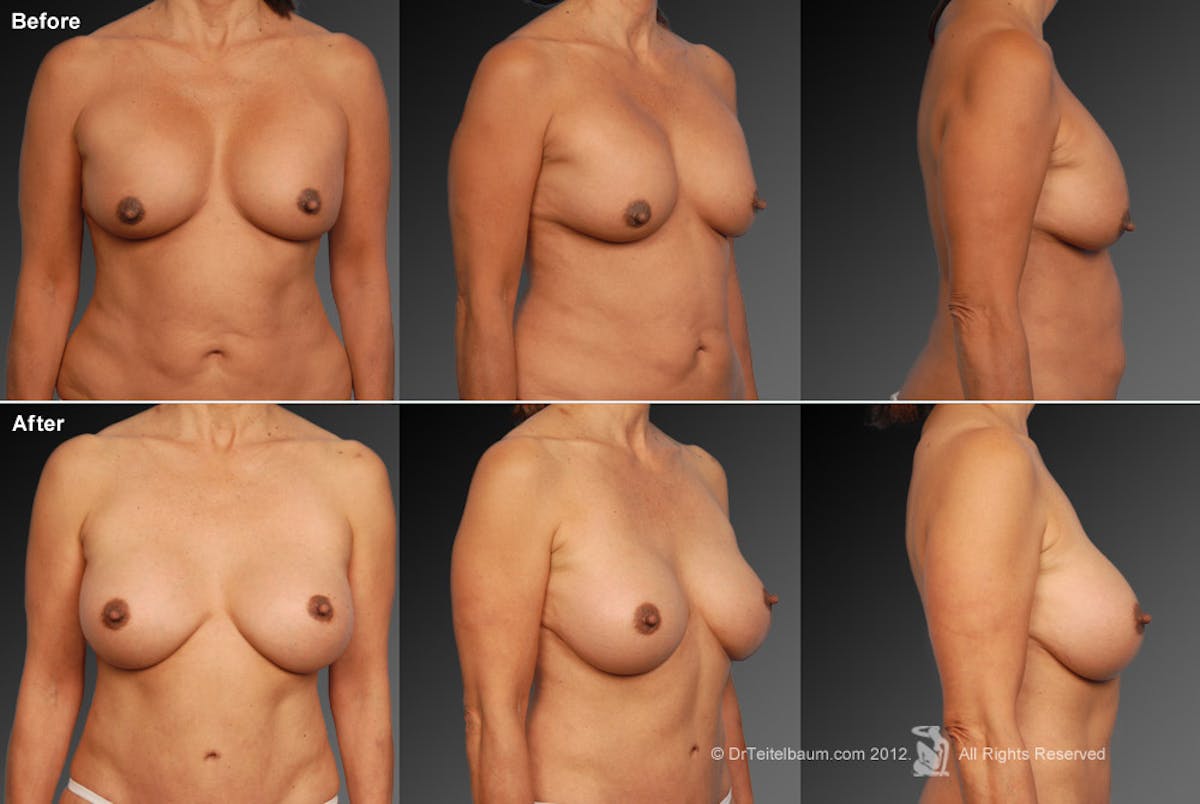 Breast Implant Revision Before & After Gallery - Patient 105600344 - Image 1