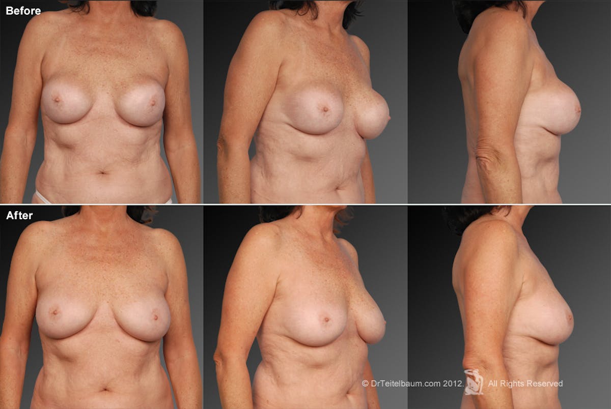 Breast Implant Revision Before & After Gallery - Patient 105600398 - Image 1