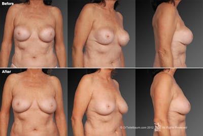 Breast Implant Revision Before & After Gallery - Patient 105600398 - Image 1