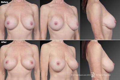 Breast Implant Revision Before & After Gallery - Patient 105600401 - Image 1