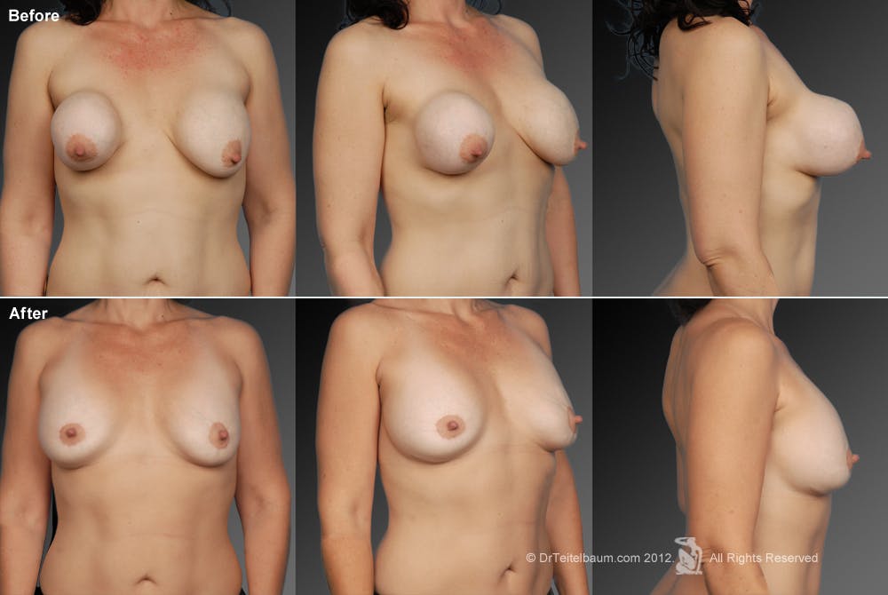 Breast Implant Revision Before & After Gallery - Patient 105600422 - Image 1