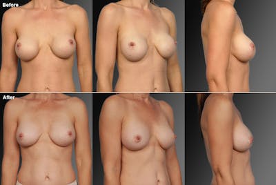 Breast Implant Revision Before & After Gallery - Patient 105620856 - Image 1