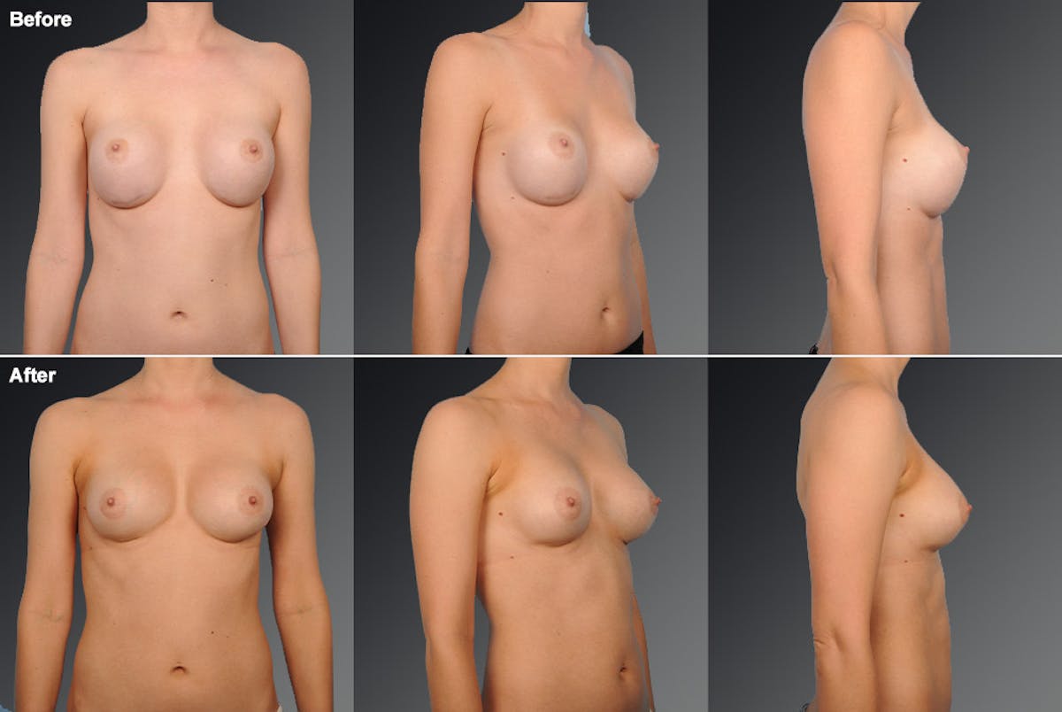 Breast Implant Revision Before & After Gallery - Patient 105620863 - Image 1