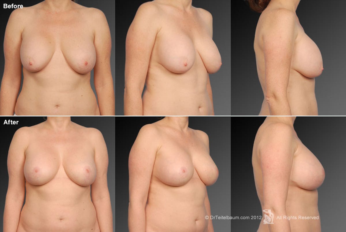 Breast Implant Revision Before & After Gallery - Patient 105620866 - Image 1