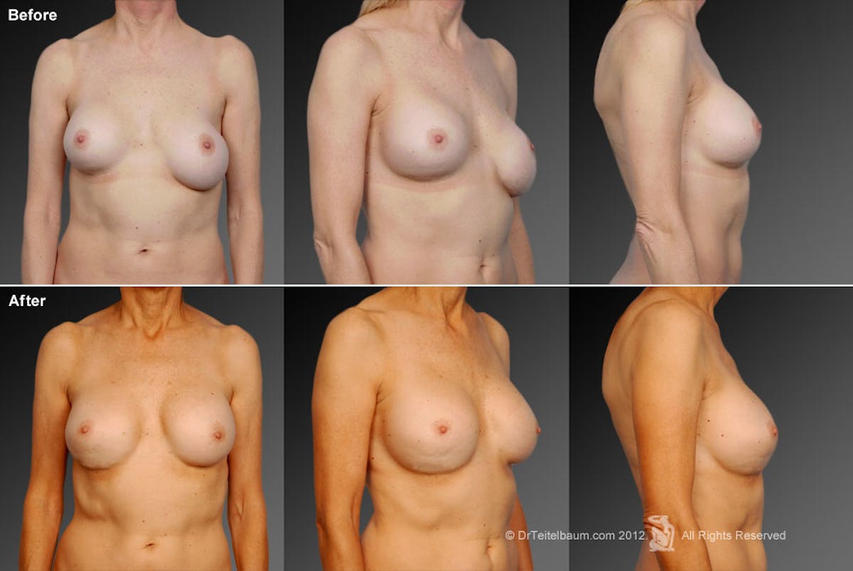 Breast Implant Revision Before & After Gallery - Patient 105620885 - Image 1