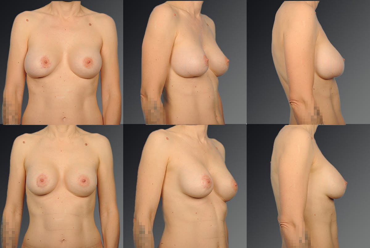 Breast Implant Revision Before & After Gallery - Patient 105620894 - Image 1
