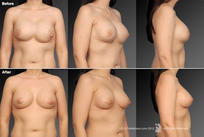 Breast Implant Revision Before & After Gallery - Patient 105620924 - Image 1