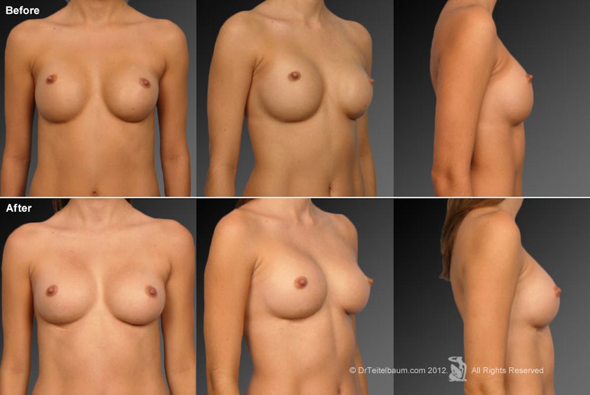 Breast Implant Revision Before & After Gallery - Patient 105620955 - Image 1