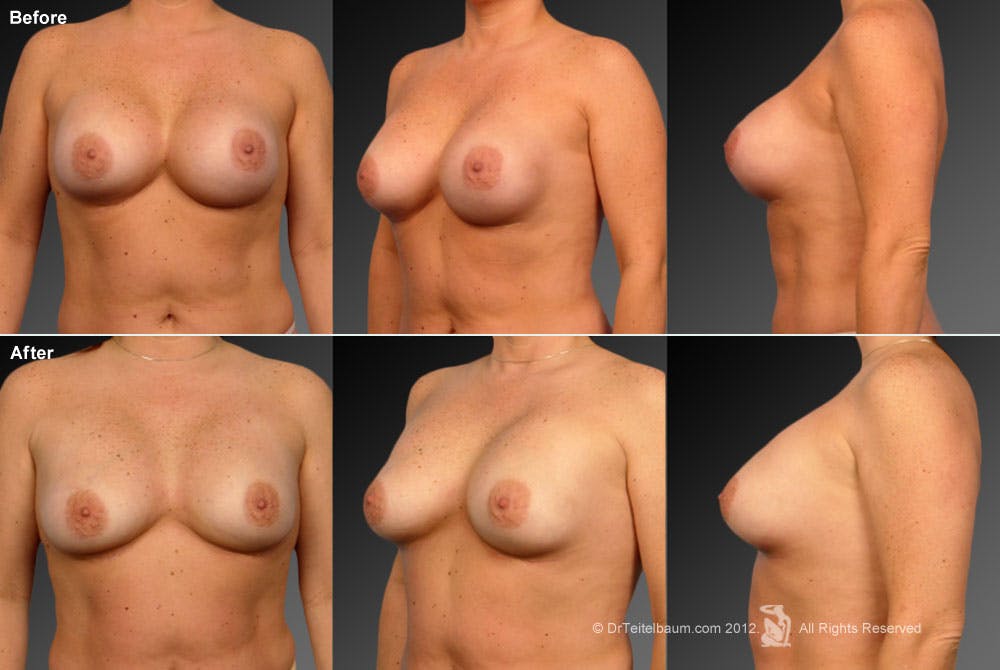 Breast Implant Revision Before & After Gallery - Patient 105621002 - Image 1