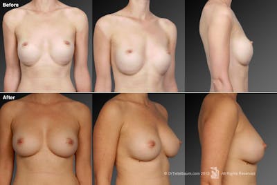 Breast Implant Revision Before & After Gallery - Patient 105622333 - Image 1