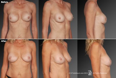 Breast Implant Revision Before & After Gallery - Patient 105622377 - Image 1