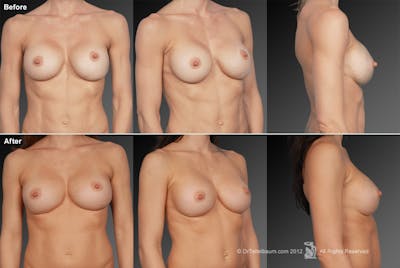 Breast Implant Revision Before & After Gallery - Patient 105622383 - Image 1
