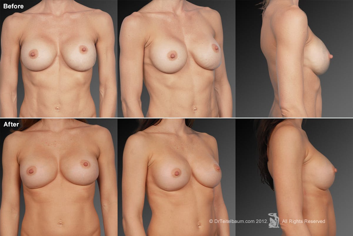 Breast Implant Revision Before & After Gallery - Patient 105622383 - Image 1