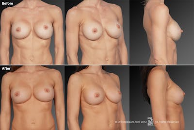 Breast Implant Revision Before & After Gallery - Patient 105622383 - Image 1