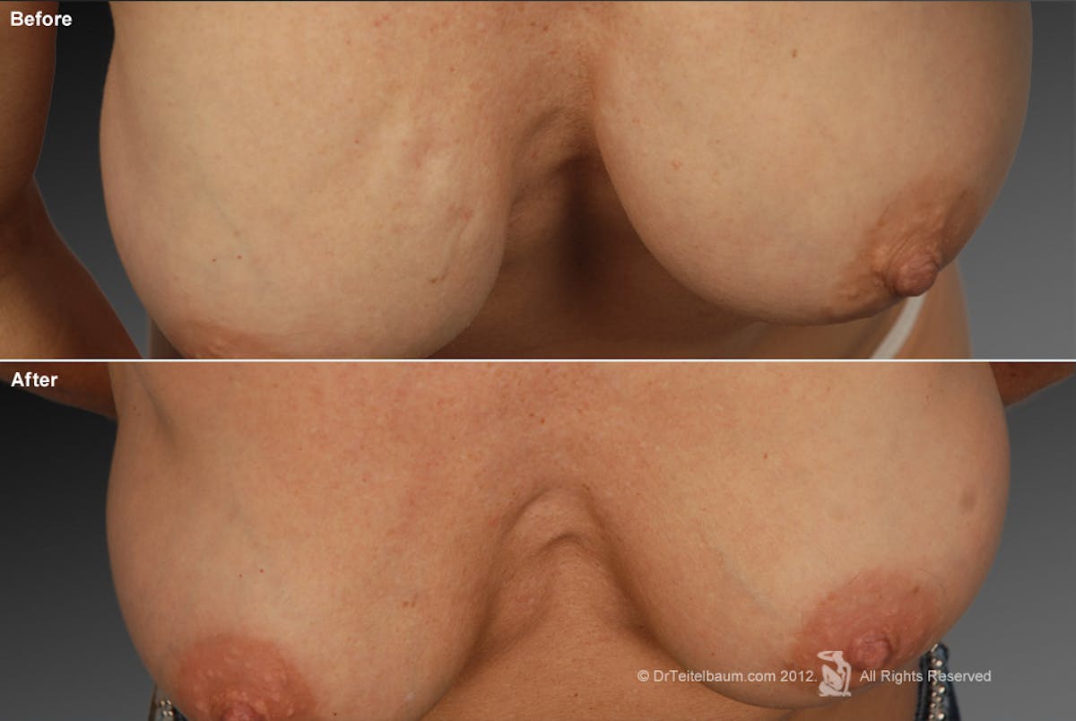 Breast Implant Revision Before & After Gallery - Patient 105622384 - Image 1