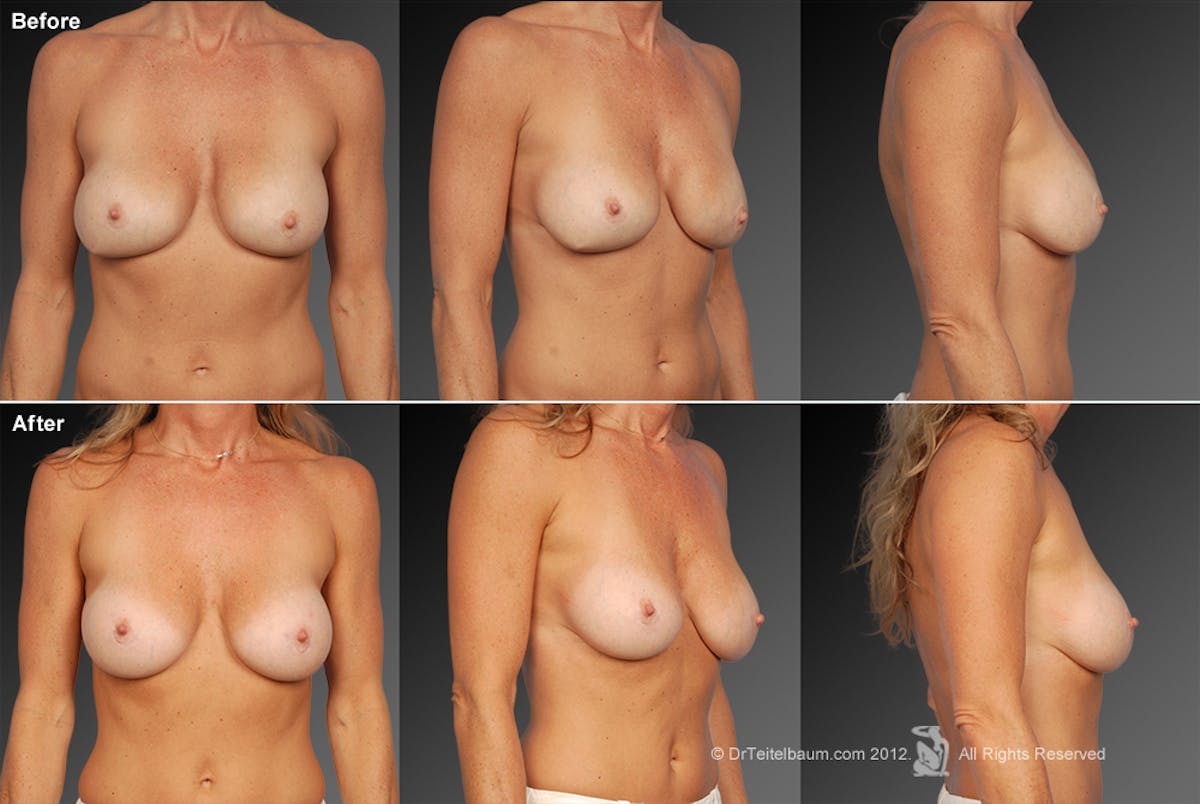 Breast Implant Revision Before & After Gallery - Patient 105622385 - Image 1