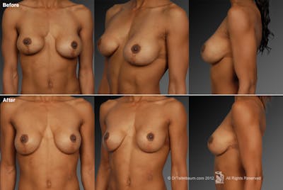 Breast Implant Revision Before & After Gallery - Patient 105622458 - Image 1