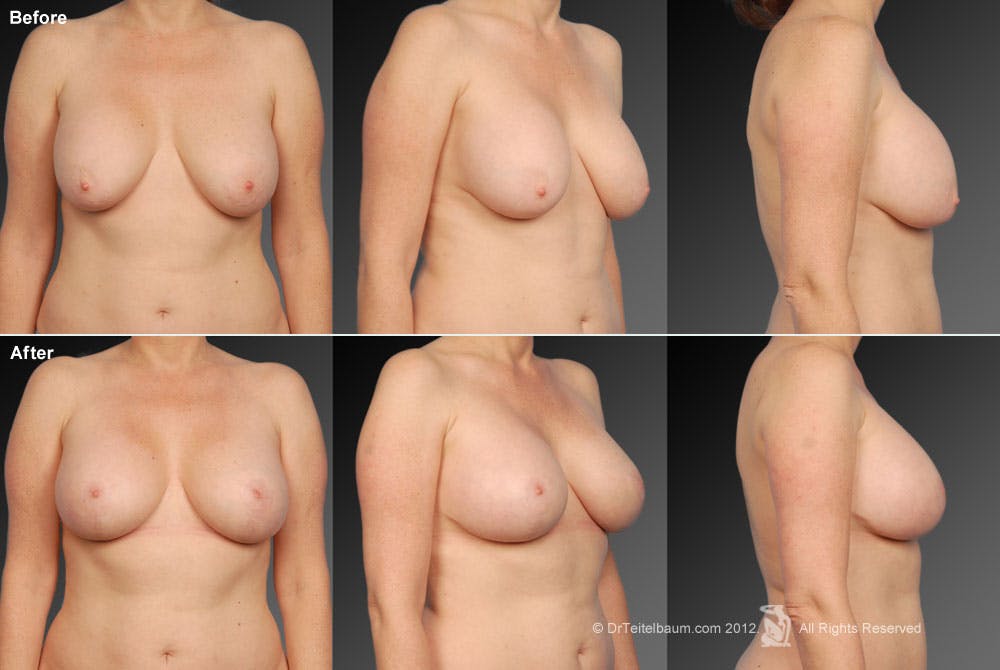 Breast Implant Revision Before & After Gallery - Patient 105636689 - Image 1