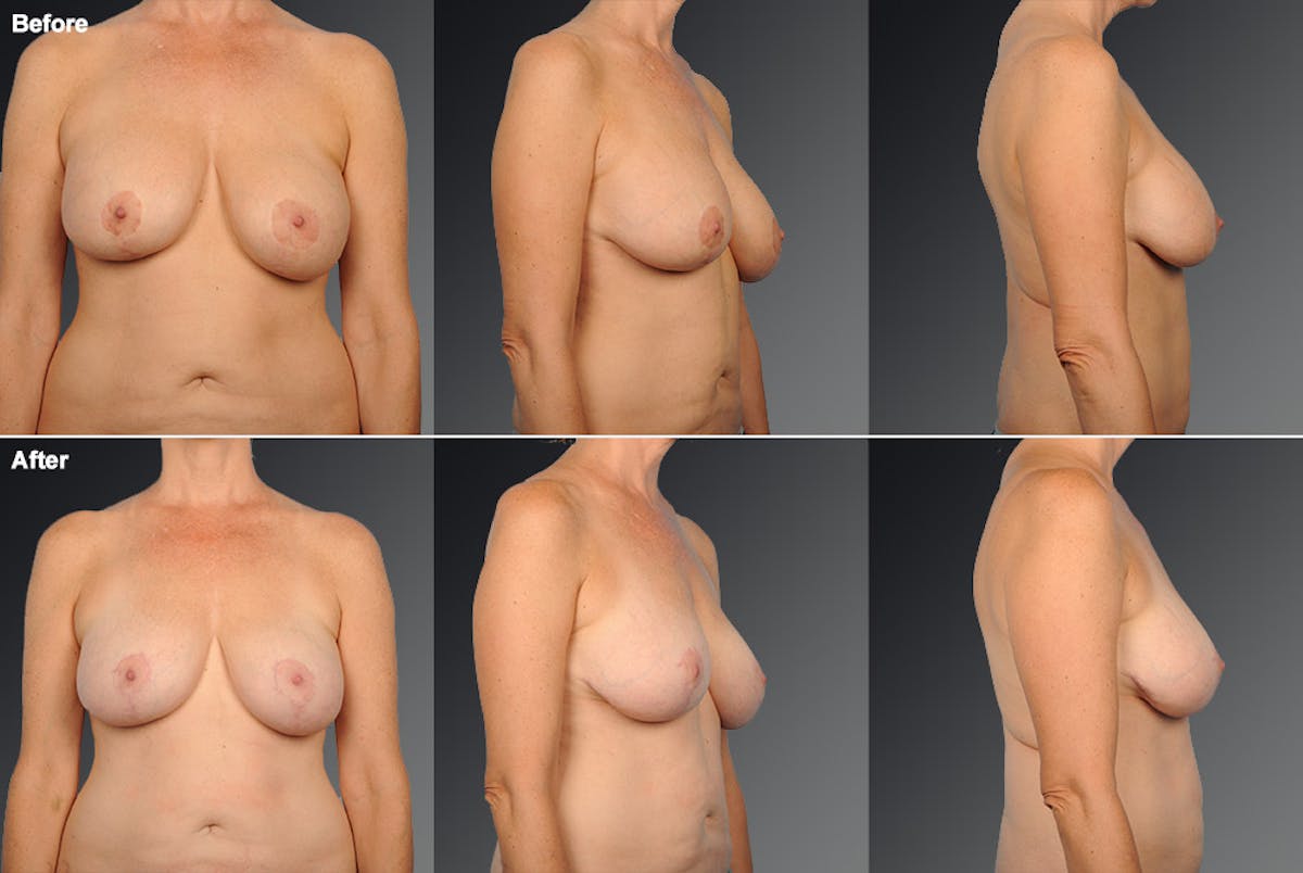 Breast Implant Revision Before & After Gallery - Patient 105636707 - Image 1