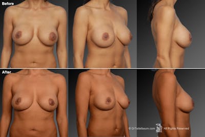 Breast Implant Revision Before & After Gallery - Patient 105636748 - Image 1