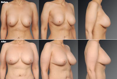 Breast Implant Revision Before & After Gallery - Patient 105636749 - Image 1
