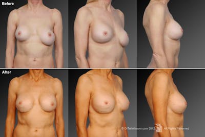 Breast Implant Revision Before & After Gallery - Patient 105636758 - Image 1