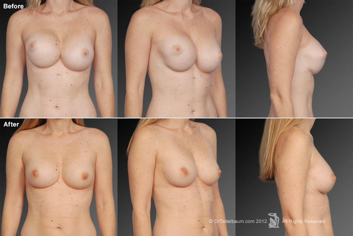 Breast Implant Revision Before & After Gallery - Patient 105636764 - Image 1