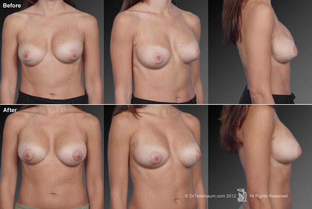 Breast Implant Revision Before & After Gallery - Patient 105655976 - Image 1