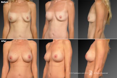 Breast Implant Revision Before & After Gallery - Patient 105655982 - Image 1