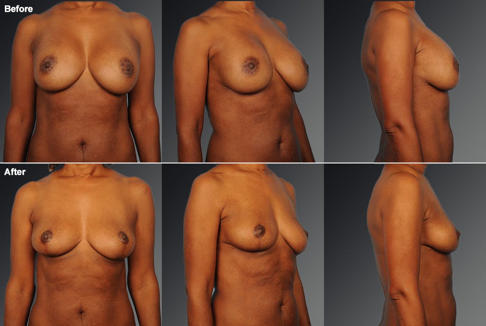 Breast Implant Revision Before & After Gallery - Patient 105655997 - Image 1