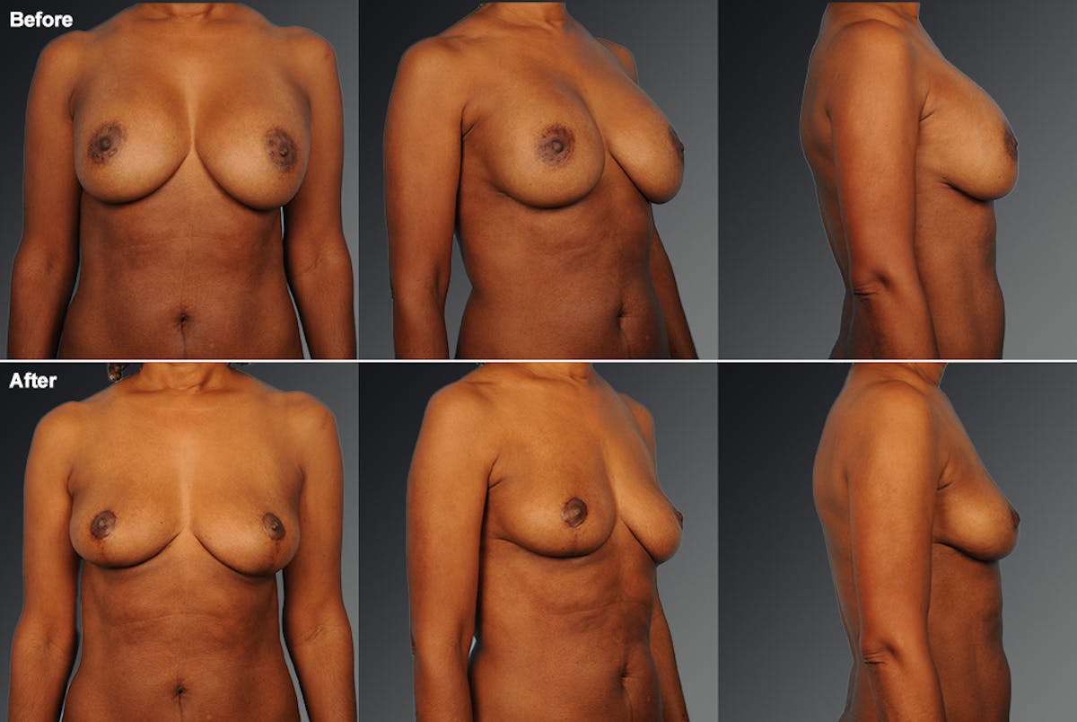 Breast Implant Revision Before & After Gallery - Patient 105655997 - Image 1