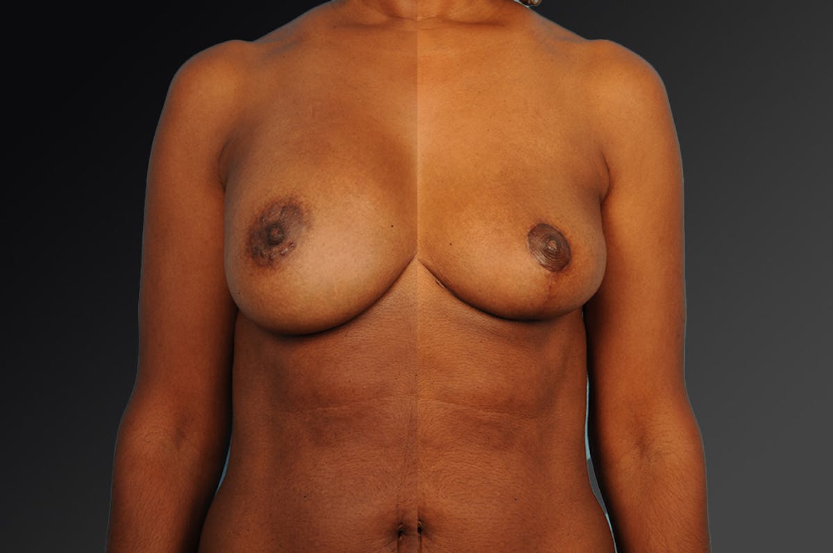 Breast Implant Revision Before & After Gallery - Patient 105655999 - Image 1