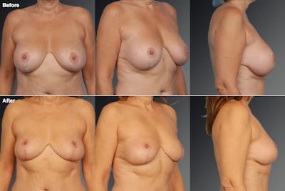Breast Implant Revision Before & After Gallery - Patient 105656000 - Image 1