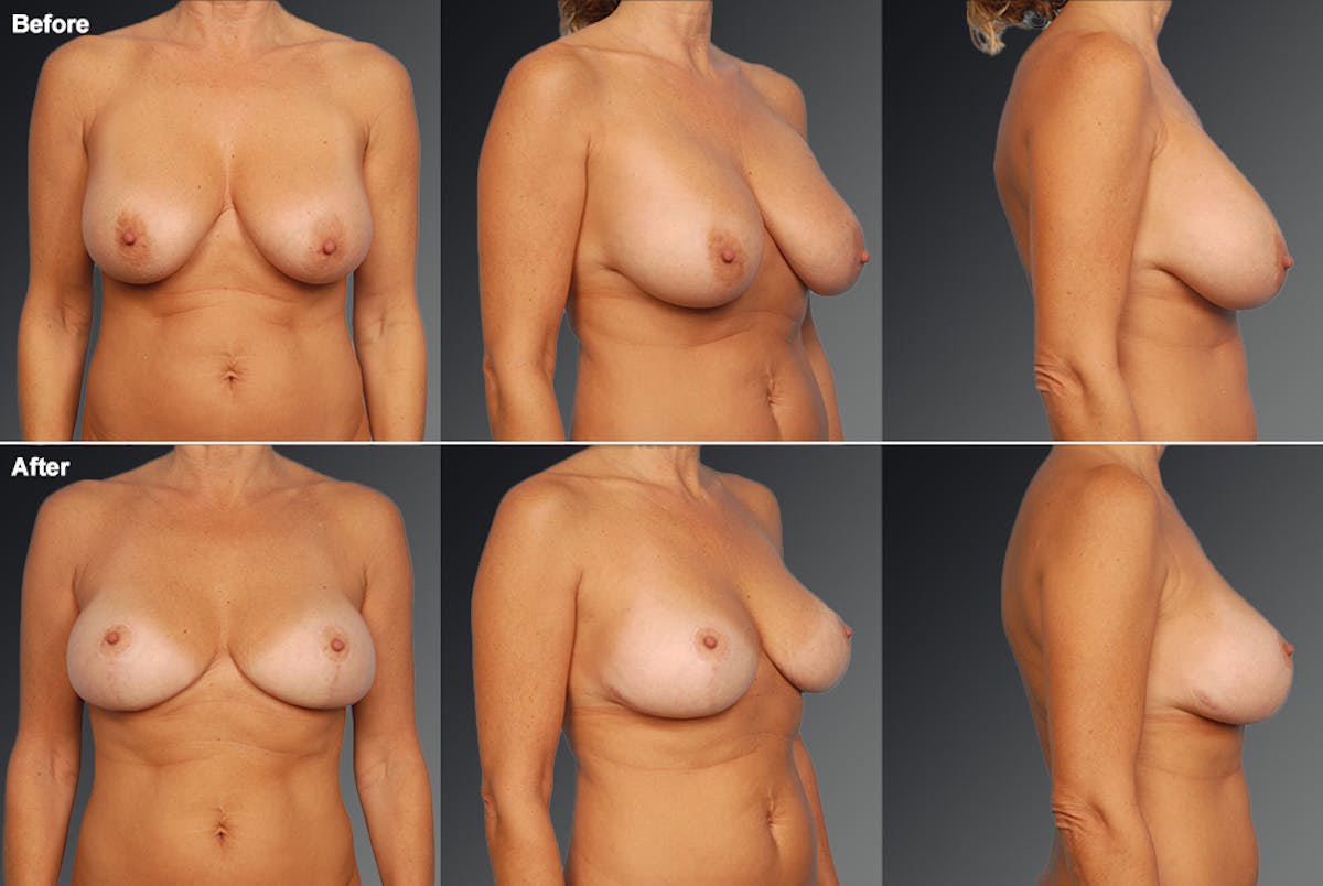 Breast Implant Revision Before & After Gallery - Patient 105656009 - Image 1
