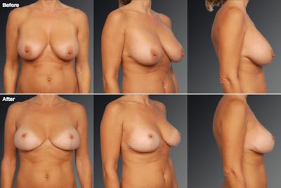 Breast Implant Revision Before & After Gallery - Patient 105656009 - Image 1