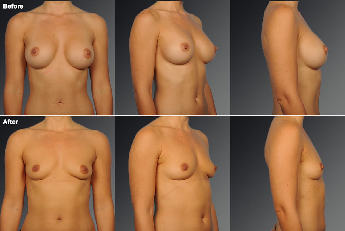 Breast Implant Revision Before & After Gallery - Patient 105656010 - Image 1
