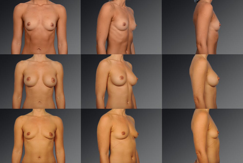 Breast Implant Revision Before & After Gallery - Patient 105656011 - Image 1