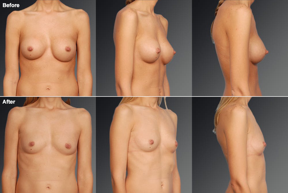 Breast Implant Revision Before & After Gallery - Patient 105656016 - Image 1