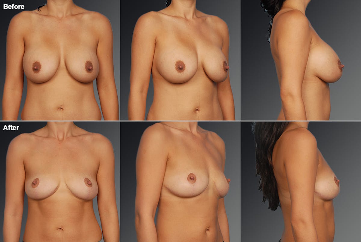 Breast Implant Revision Before & After Gallery - Patient 105656017 - Image 1