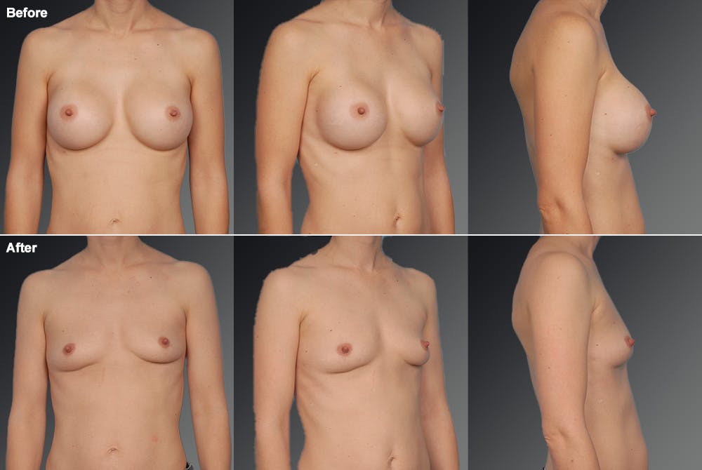 Breast Implant Revision Before & After Gallery - Patient 105656019 - Image 1
