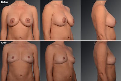 Breast Implant Revision Before & After Gallery - Patient 105656025 - Image 1