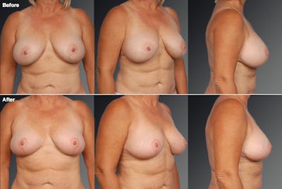 Breast Implant Revision Before & After Gallery - Patient 105656034 - Image 1
