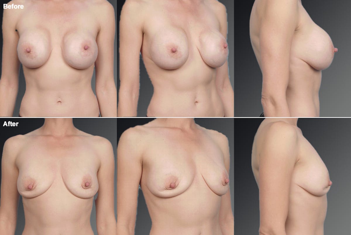 Breast Implant Revision Before & After Gallery - Patient 105656045 - Image 1