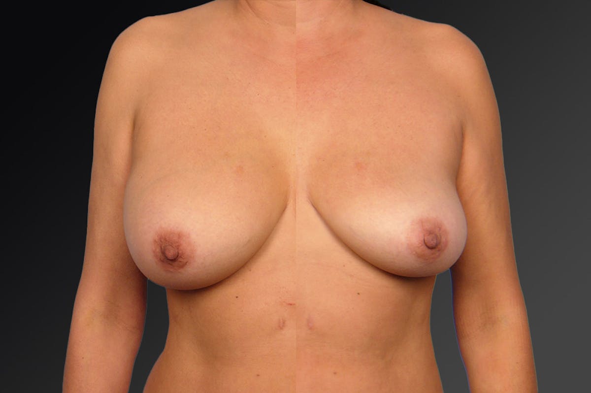 Breast Implant Revision Before & After Gallery - Patient 105656052 - Image 1