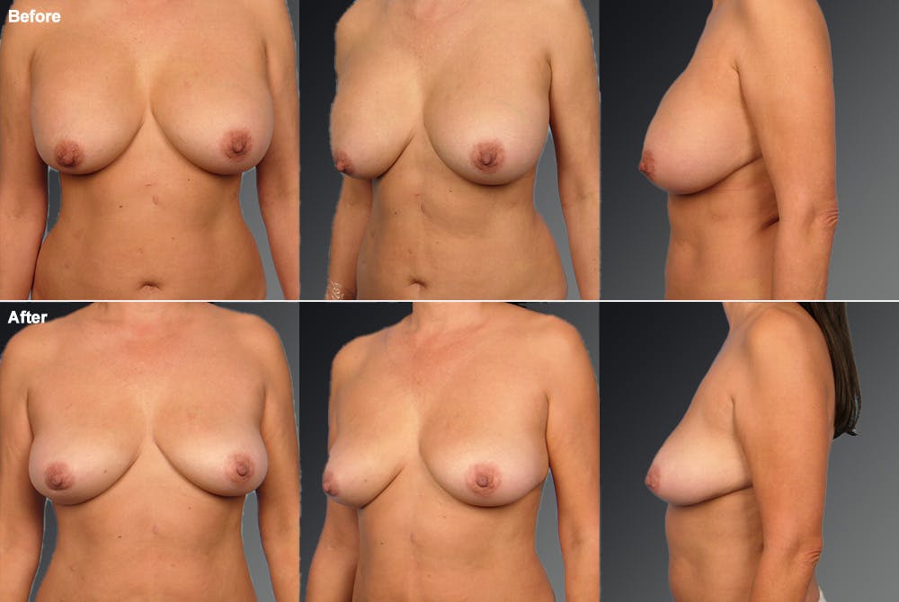Breast Implant Revision Before & After Gallery - Patient 105656066 - Image 1